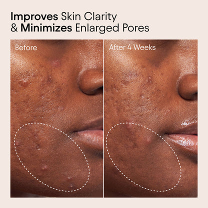 Before and after results of using Alpyn Beauty 2% BHA Pore Perfecting Liquid Exfoliator for Brighter and Clearer Skin