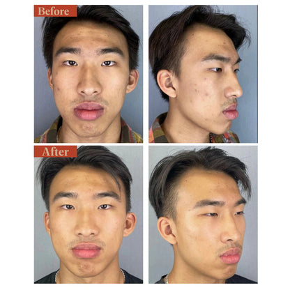 Before and after results of using Dr. Few Clean Retinol