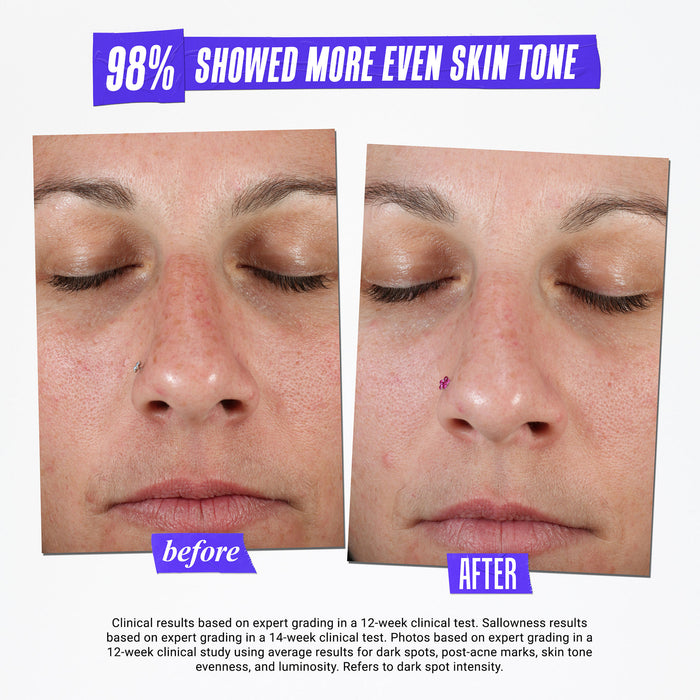 Before and after results of using Kiehl's Since 1851 Clearly Corrective Dark Spot Solution variant: 1 oz