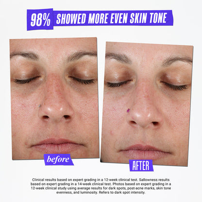 Before and after results of using Kiehl's Since 1851 Clearly Corrective Dark Spot Solution variant: 1 oz