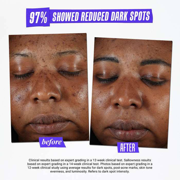 Before and after results of using Kiehl's Since 1851 Clearly Corrective Dark Spot Solution variant: 1 oz