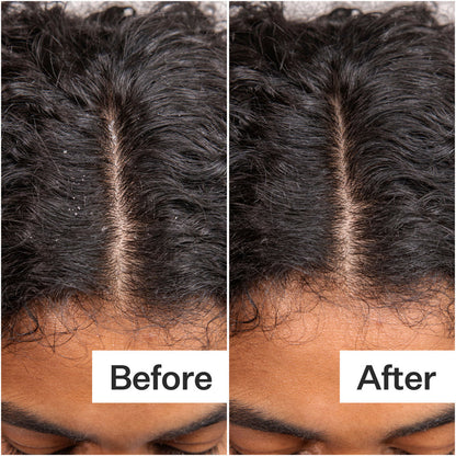 Before and after results of using Act+Acre Daily Hydro Scalp Serum with Hyaluronic Acid for Dry Scalp