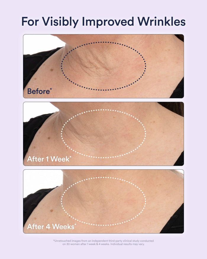 Before and after comparison of visibly improved wrinkles on a person's neck.