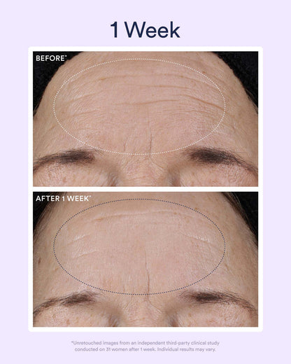 One-week before-and-after images demonstrating visible smoothing of forehead lines