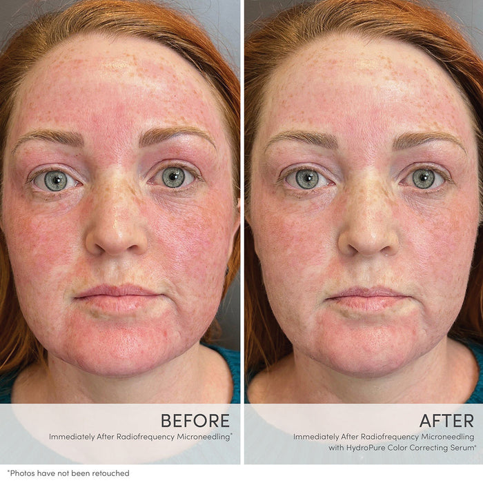 Before and after results of using Jane Iredale HydroPure Color Correcting Serum with Hyaluronic Acid and CoQ10