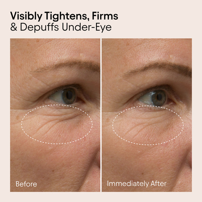 Before and after results of using Alpyn Beauty Line-Filling Eye Cream with Bakuchiol and Caffeine