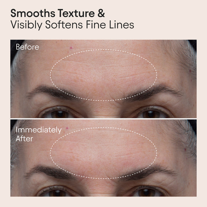 Before and after results of using Alpyn Beauty Polishing Peel and Brightening Face Mask with 8 Acids and Huckleberry