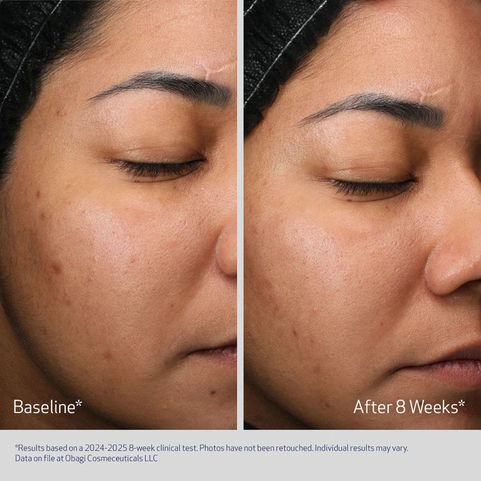 Before and after results of using Obagi Retinol + PHA Refining Night Cream