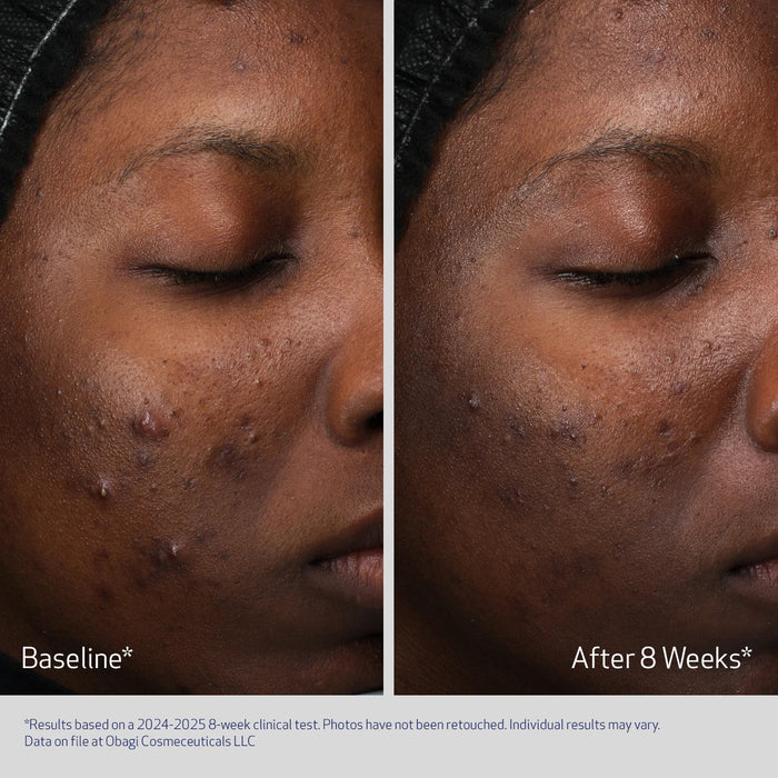 Before and after results of using Obagi Retinol + PHA Refining Night Cream