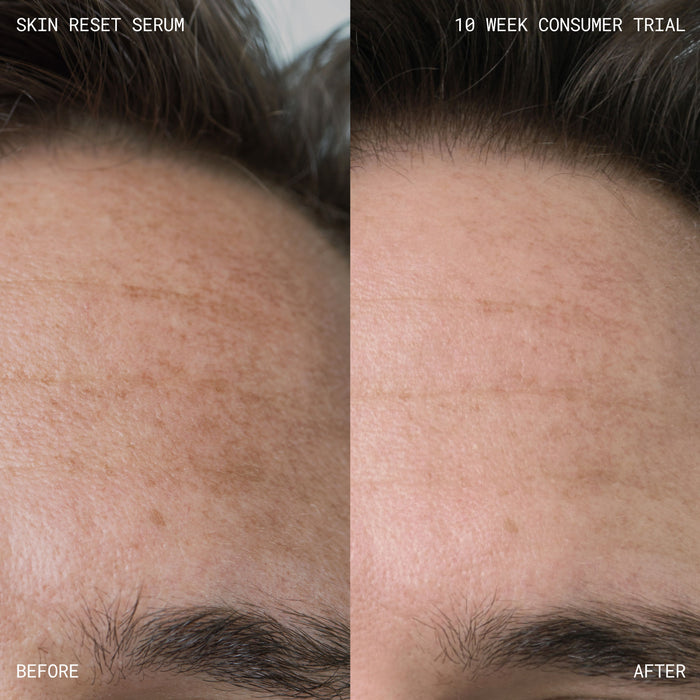 Before and after results of using Emma Lewisham Skin Reset Face Serum