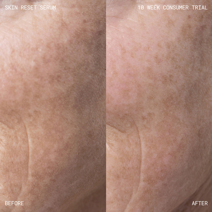 Before and after results of using Emma Lewisham Skin Reset Face Serum