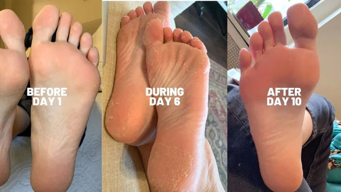 Before and after results of using Baby Foot Spa Bundle