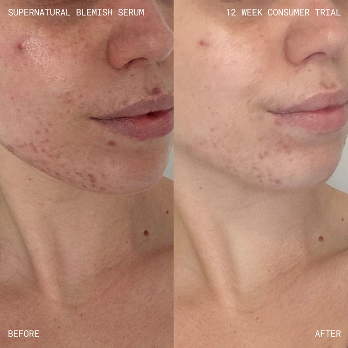 Before and after results of using Emma Lewisham Supernatural Blemish Face Serum