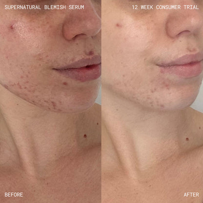 Before and after results of using Emma Lewisham Supernatural Blemish Face Serum