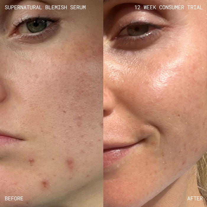 Before and after results of using Emma Lewisham Supernatural Blemish Face Serum