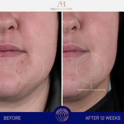 Before and after results of using Augustinus Bader The Rich Cream variant: 1 fl oz